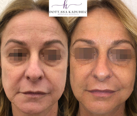 Trattamento laser rassodante