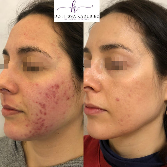 Il risultato dopo quattro sedute di trattamento laser delle cicatrici da acne