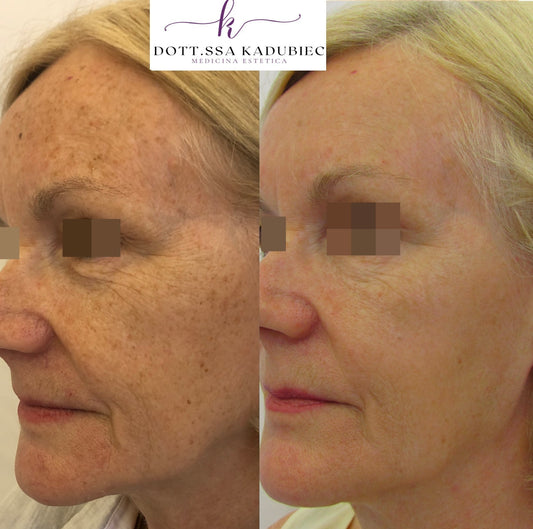 I risultati dopo 3 sedute di fotoringiovanimento con laser Nordlys (Candela)