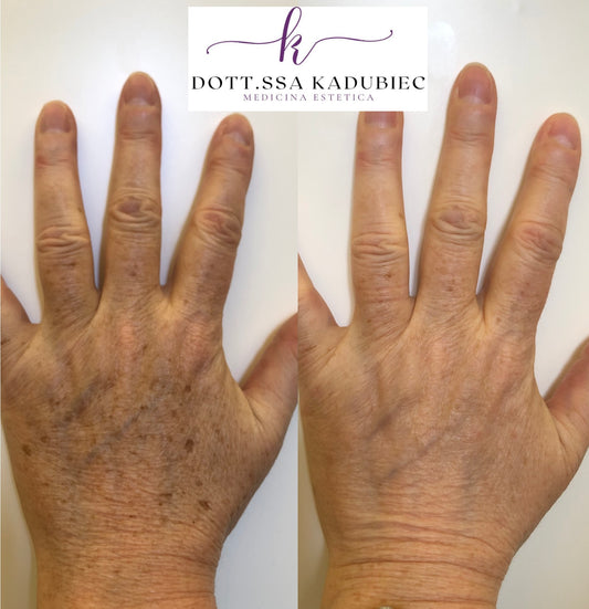 Trattamento laser delle macchie cutanee