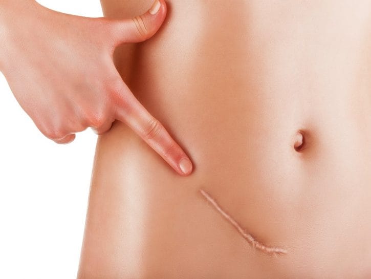 Trattamento Cicatrici